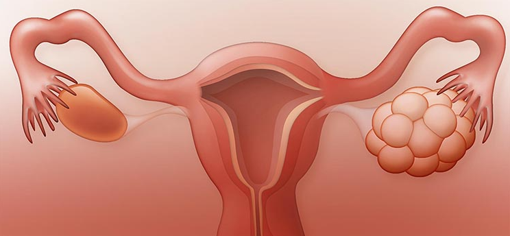 Sindrome de Ovario Poliquistico